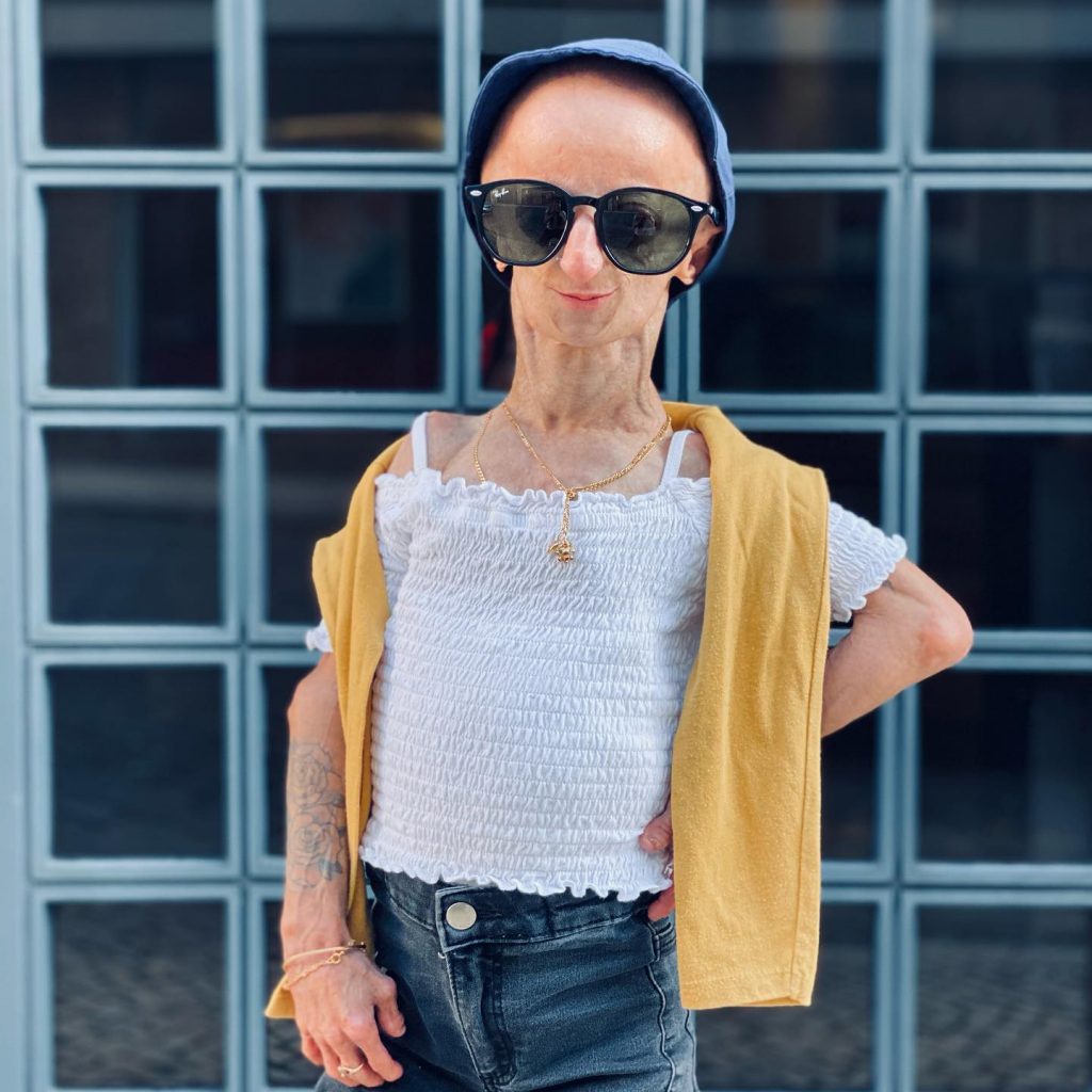 Cláudia Amaral, a jovem que sofria de progeria, faleceu em novembro de 2021