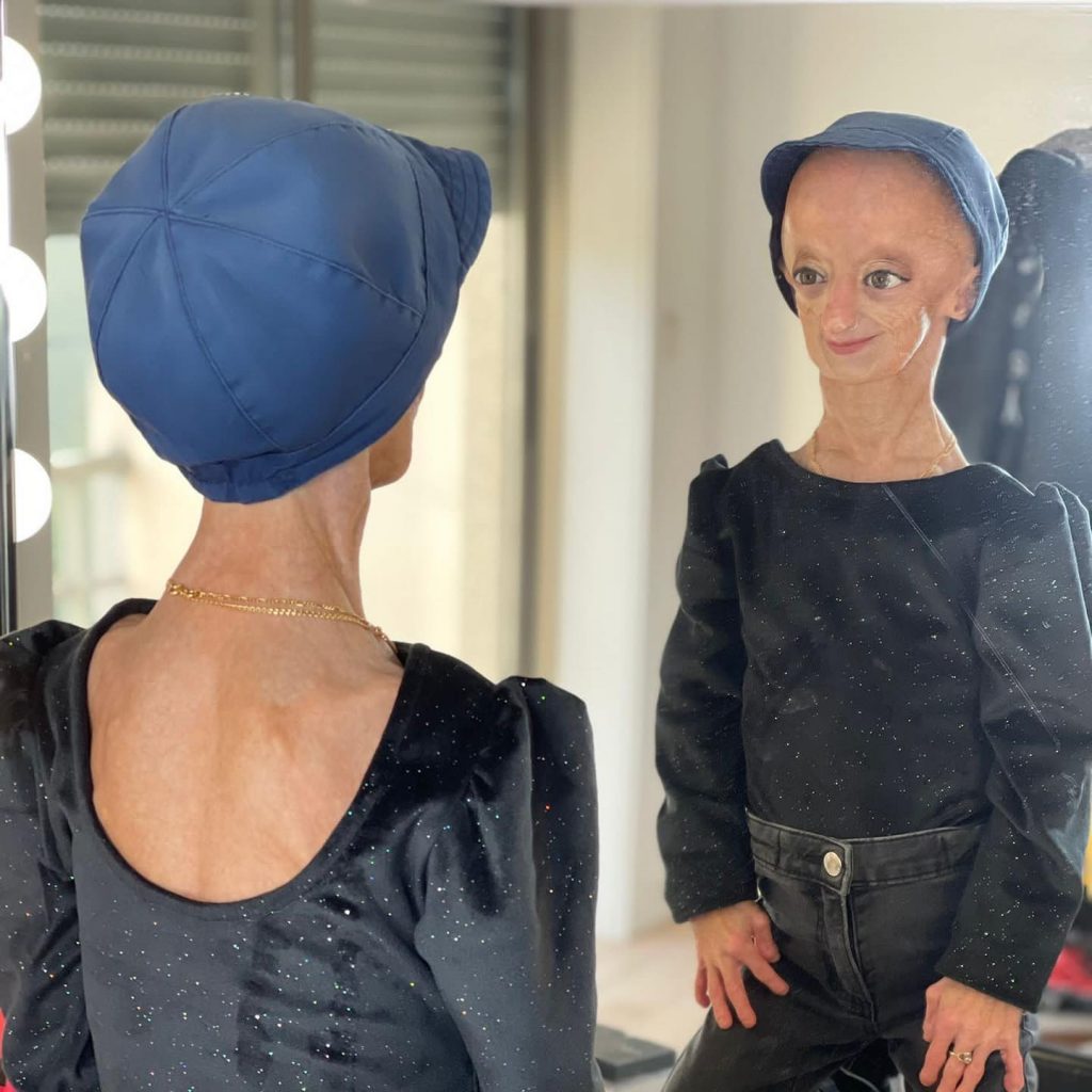 Cláudia Amaral, a jovem que sofria de progeria, faleceu em novembro de 2021